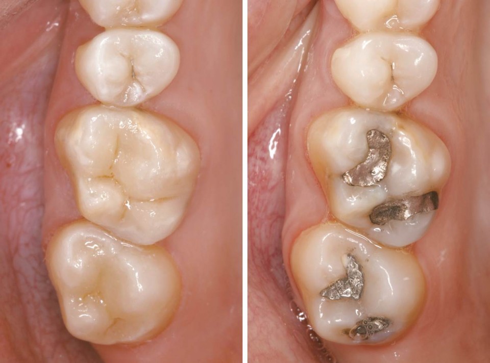 cerec porcelain inlays